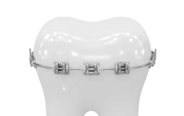 A shiny white molar tooth with silver metal braces on a transparent background.