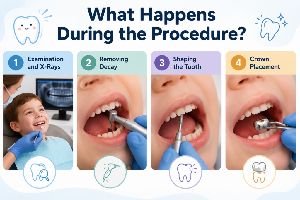 Child receiving a dental crown procedure showing examination, decay removal, tooth shaping, and crown placement.
